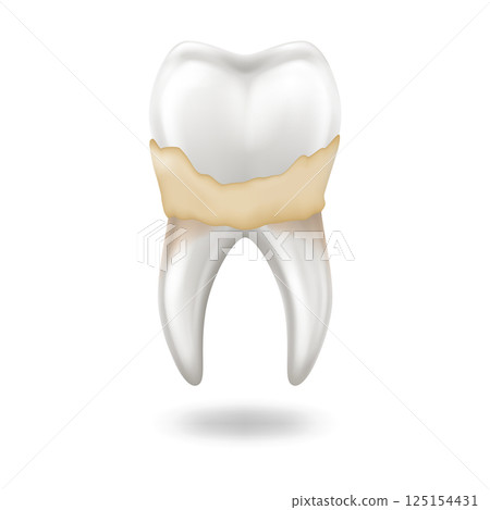 Illustration of Tooth with Plaque or Tartar 125154431