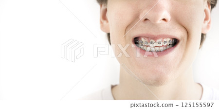 A teenager with dental braces holds interdental brush for cleaning teeth. 125155597