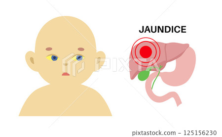 Jaundice yellow skin 125156230