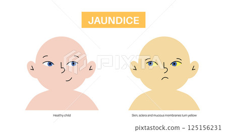 Jaundice yellow skin Jaundice yellow skin 125156231