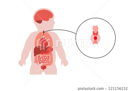 Thyroid diseases in a child Thyroid diseases in a child 125156232