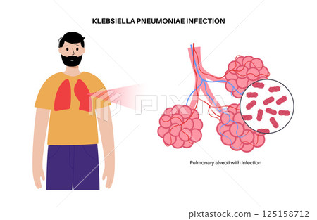 Klebsiella pneumoniae poster 125158712