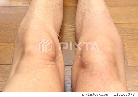 Painful swelling on the outside of the right knee that cannot be bent 125163078