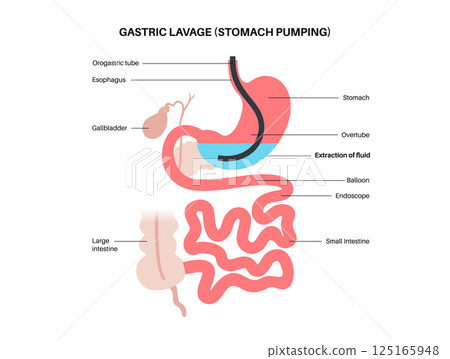 Stomach wash gastric lavage 125165948