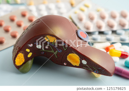Liver model with pill drug treatment, Cirrhosis, Liver cancer, fatty liver. Liver model with pill drug treatment, Cirrhosis, Liver cancer, fatty liver. 125179825