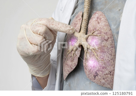 Doctor pointing at lungs model with highlighted problem areas in medical examination 125180791