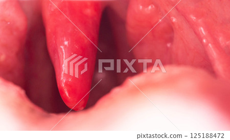 Red, inflamed and swollen uvula in the throat. Treatment of uvulitis due to bacteria and streptococcal viruses. Otolaryngology, macro. Copy space for text. Allergy 125188472