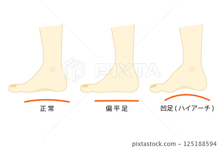 Illustration set of normal feet and cavus/flat feet 125188594