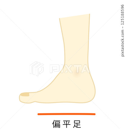 Flat foot illustration Flat foot illustration 125188596