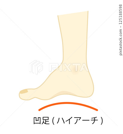 Illustration of a high arched foot Illustration of a high arched foot 125188598