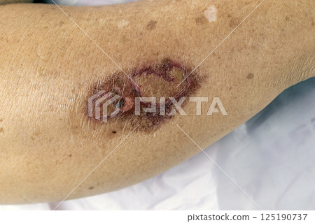 A medical image showing a scald on the skin of the body. 125190737
