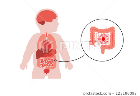 Intestines diseases in a child 125196092