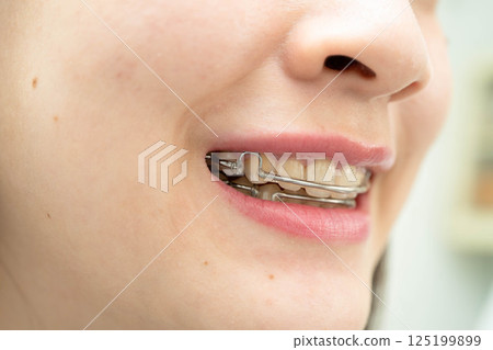 Asian woman wearing Hawley retainer removable orthodontic appliance maintain position of teeth. Asian woman wearing Hawley retainer removable orthodontic appliance maintain position of teeth. 125199899