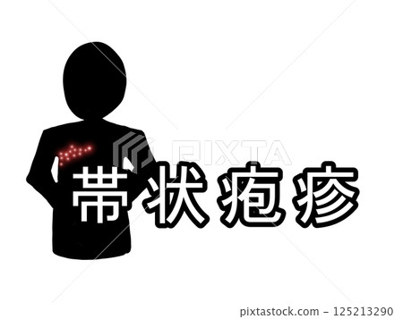 病名:帶狀皰疹 病名:帶狀皰疹 125213290