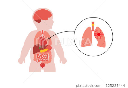 Lung diseases in a child 125225444