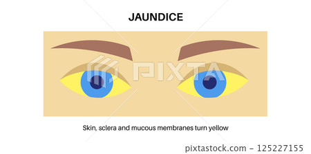 Jaundice yellow skin 125227155