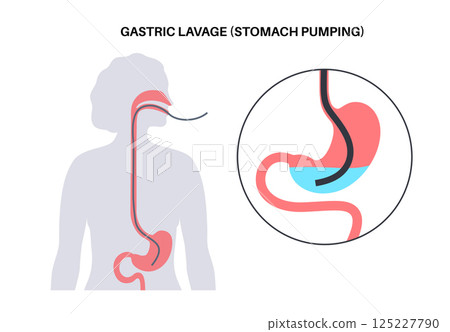 Stomach wash gastric lavage 125227790