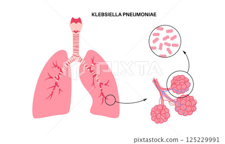 Klebsiella pneumoniae poster 125229991