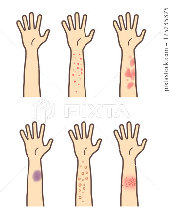 帶狀皰疹、濕疹、膿皰和瘀傷的一組武器 125235375