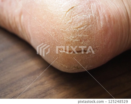 Dry and cracked right heel Dry and cracked right heel 125248529