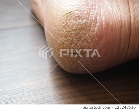 Dry and cracked right heel Dry and cracked right heel 125248530