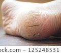 Dry and cracked right heel 125248531