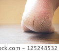 Dry and cracked right heel 125248532