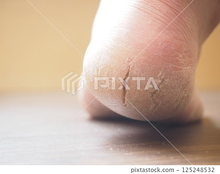 右腳跟乾燥開裂 右腳跟乾燥開裂 125248532