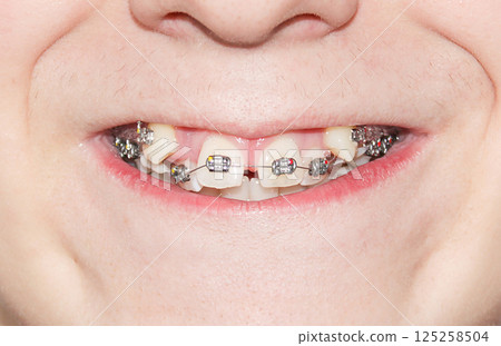 crooked growing teeth after visiting the dentist and installing braces 125258504