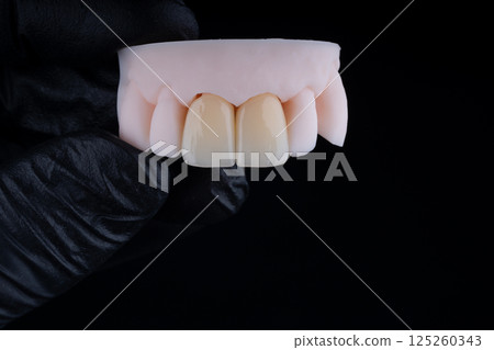 High-quality dental single crowns made of zirconium for fixation to the frontal teeth of upper jaw. 125260343