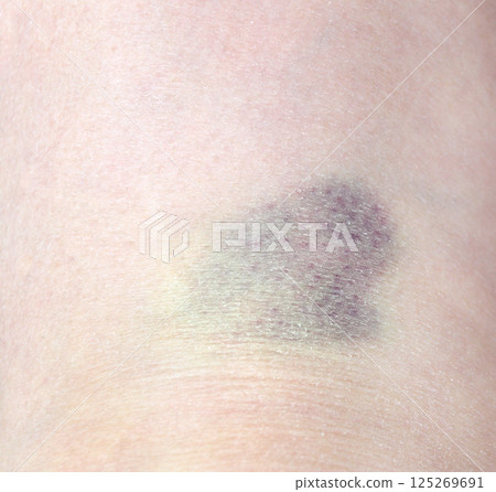 Close up purple bruise on skin. Bruise from impact. Bruising and hematoma on human body 125269691