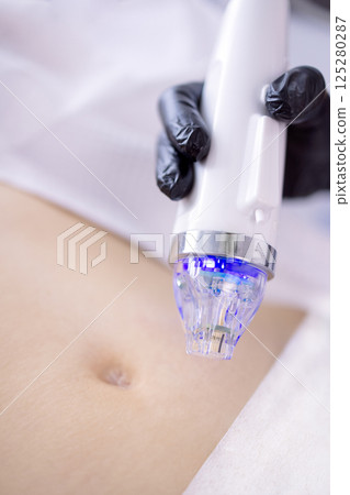 Microneedle RF lifting procedure. Hardware cosmetology. 125280287