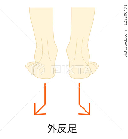 Illustration of valgus foot 125280471