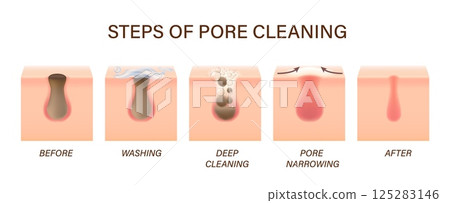 Skin pores cleaning steps for face acne and facial cleanser treatment, vector process. Skin care foam cleaner for blackhead and dirty cells clogged with sebum, pores cleaning infographic for cleanser Skin pores cleaning steps for face acne and facial cleanser treatment, vector process. Skin care foam cleaner for blackhead and dirty cells clogged with sebum, pores cleaning infographic for cleanser 125283146
