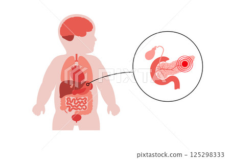 Pancreas diseases in a child 125298333