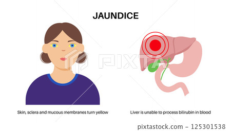 Jaundice yellow skin 125301538