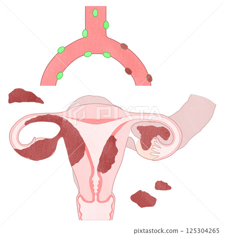 Ovarian cancer stage III (stage 3) - easy-to-understand illustration Ovarian cancer stage III (stage 3) - easy-to-understand illustration 125304265