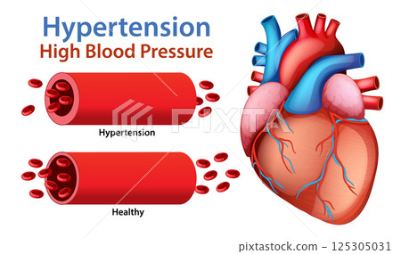 Hypertension and Heart Health Vector Illustration Hypertension and Heart Health Vector Illustration 125305031