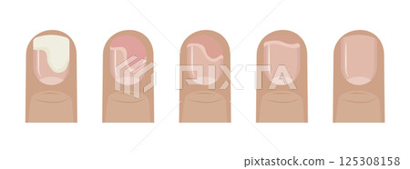 Stages of fingernail treatment showing onycholysis healing process 125308158