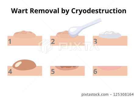 Dermatologist removing wart using cryodestruction procedure in six steps Dermatologist removing wart using cryodestruction procedure in six steps 125308164