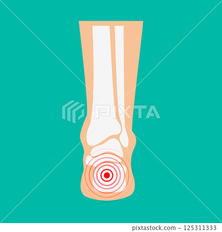 Human leg pain zones. Design elements for infographic. Vector illustration. Human leg pain zones. Design elements for infographic. Vector illustration. 125311333