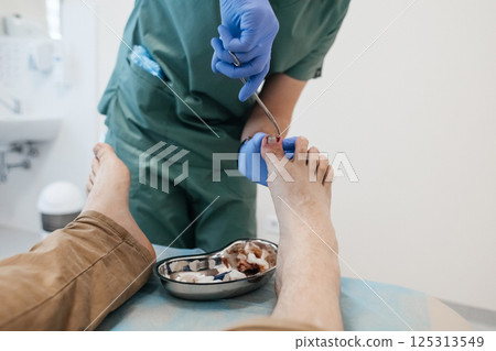 Resection of the nail plate, removal of ingrown nail. Dressing after surgery on the toe. Surgical treatment of onychocryptosis, paronychia and purulent disease Resection of the nail plate, removal of ingrown nail. Dressing after surgery on the toe. Surgical treatment of onychocryptosis, paronychia and purulent disease 125313549