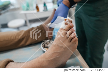 Resection of the nail plate, removal of ingrown nail. Dressing after surgery on the toe. Surgical treatment of onychocryptosis, paronychia and purulent disease 125313555