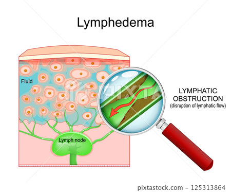 Lymphedema. Lymphatic vessel with disrupted lymph flow is visible through the magnifying glass. 125313864