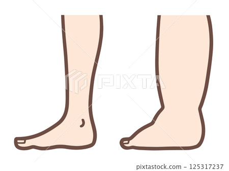 Comparison of normal and swollen feet Comparison of normal and swollen feet 125317237