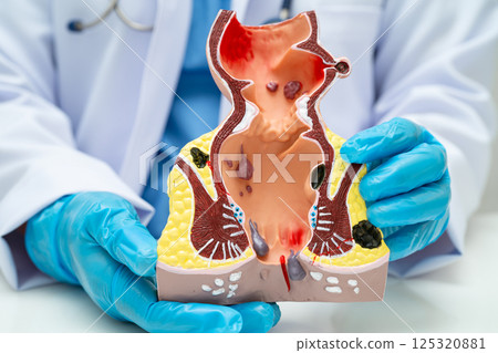 Asian doctor with rectum and hemorrhoid human anatomy model at hospital, inflamed vascular structure. Asian doctor with rectum and hemorrhoid human anatomy model at hospital, inflamed vascular structure. 125320881