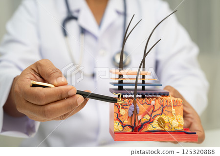 Hair transplant, Asian dermatologist doctor holding skin structure anatomy model for treatment in hospital. 125320888