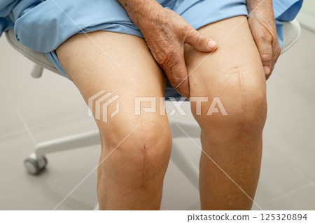 Asian elderly woman patient with scar knee replacement surgery in hospital. Asian elderly woman patient with scar knee replacement surgery in hospital. 125320894