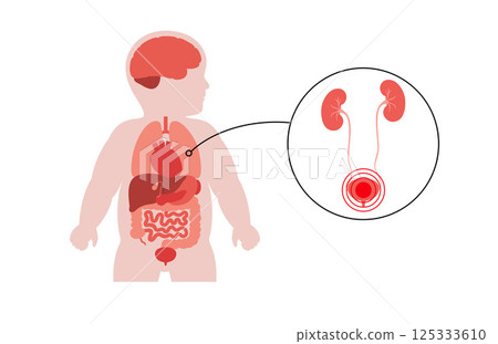 Kidney diseases in a child 125333610