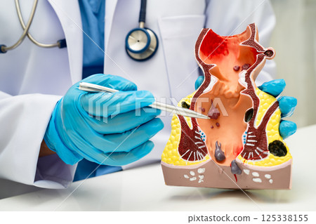 Asian doctor with rectum and hemorrhoid human anatomy model at hospital, inflamed vascular structure. 125338155